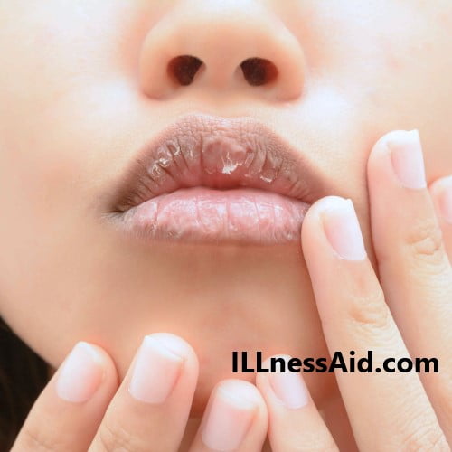 remedies for chapped lips