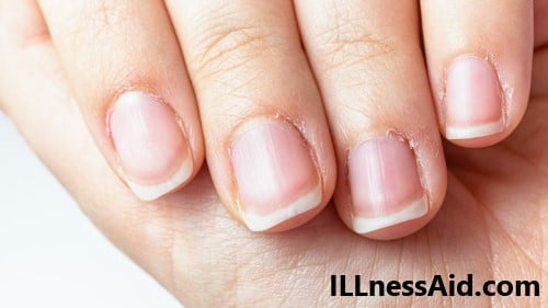 how to get rid of hangnails