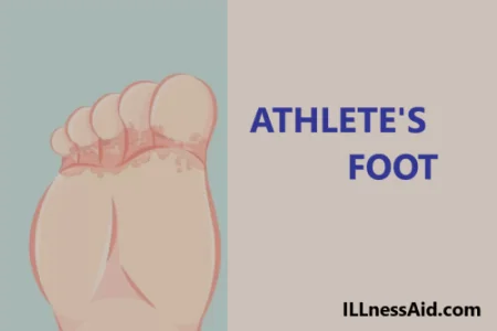 home remedies for athlete's foot