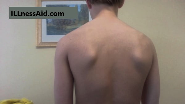 scapular dyskinesis