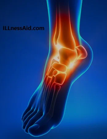 high ankle sprain photo