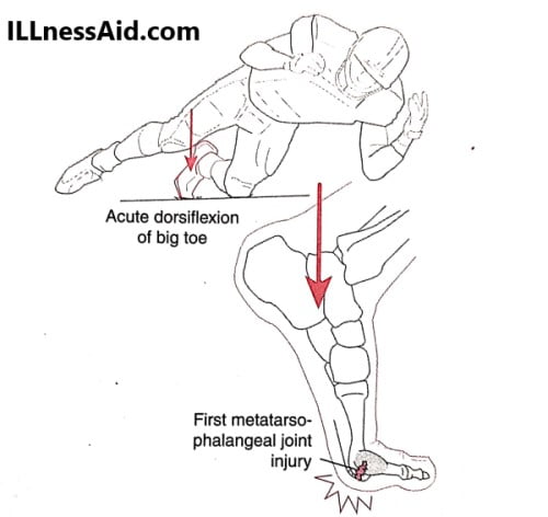 mechanism of injury for turf toe