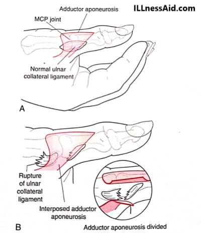 Anatomy of skier's thumb