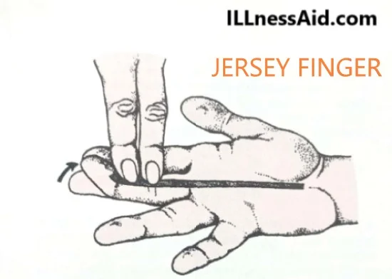 JERSEY FINGER