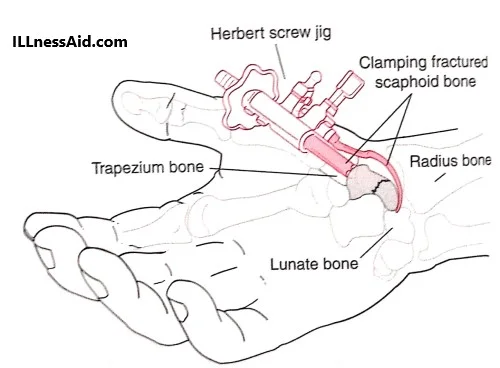 ORIF placement for scaphoid fracture