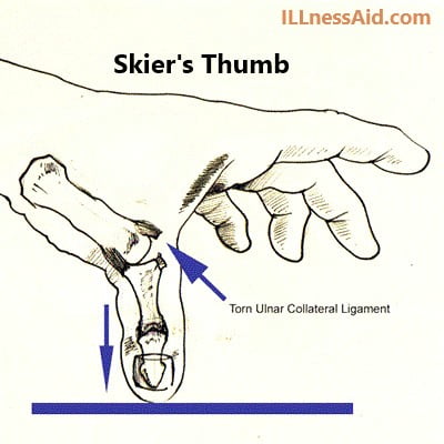 Skier's thumb