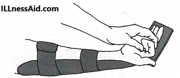 combined passive exercises for scaphoid fracture