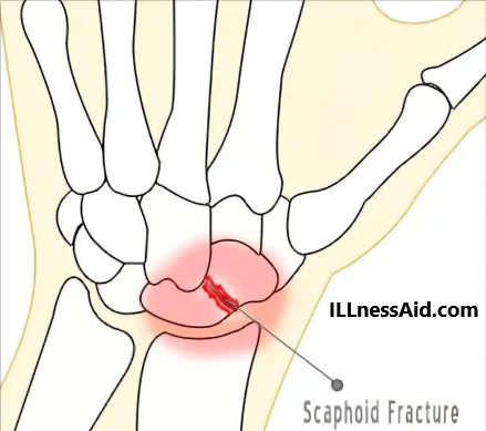 scaphoid fracture