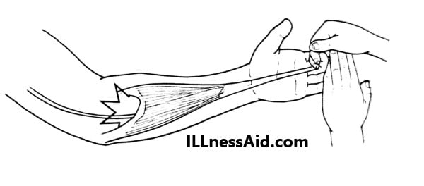 flexor digitorum superficialis test