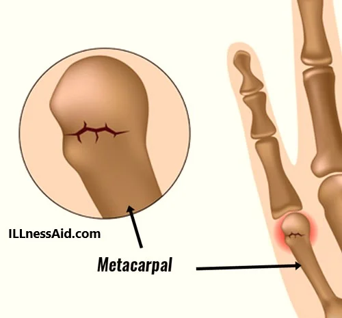 boxer's fracture