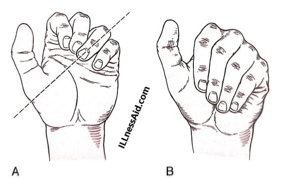 boxer's fracture angulation