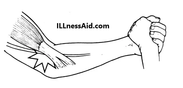 lacertus fibrosus test