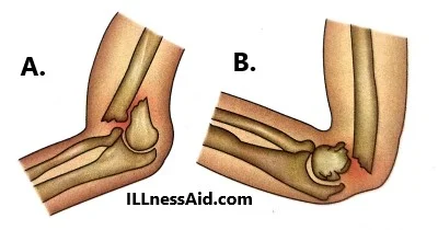 supracondylar fracture types