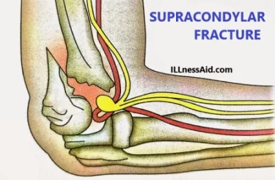 supracondylar fracture