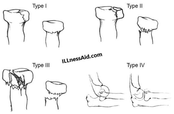 classification of radial head fracture