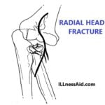 radial head fracture