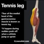 tennis leg