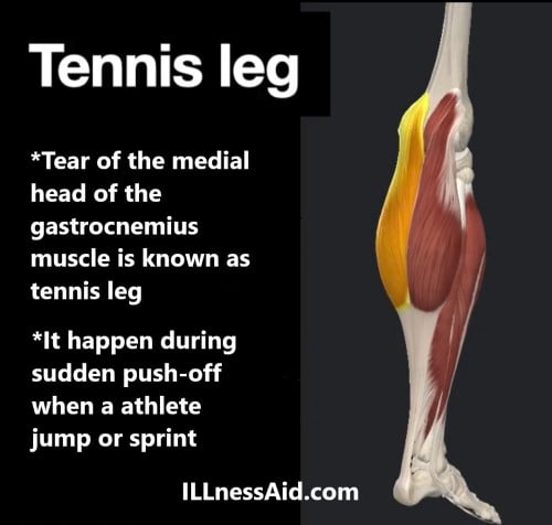 tennis leg