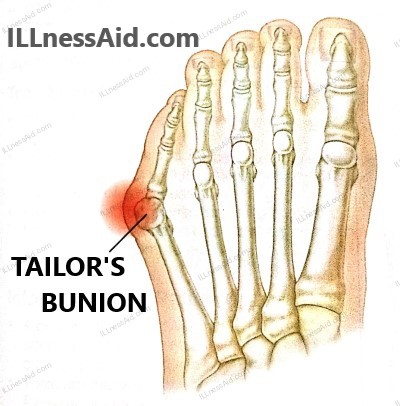 tailor's bunion