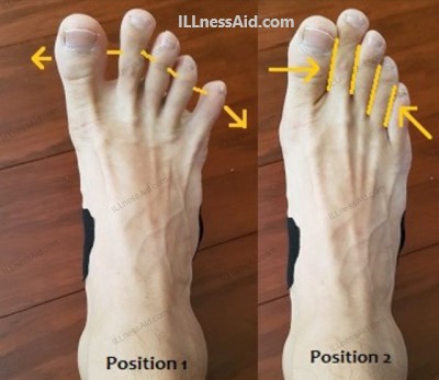 toe spread exercise