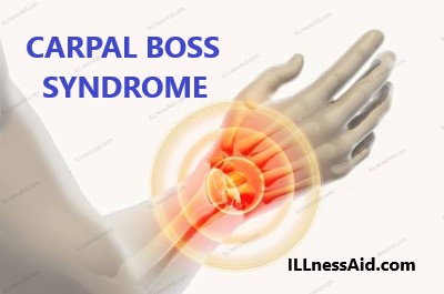 carpal boss syndrome