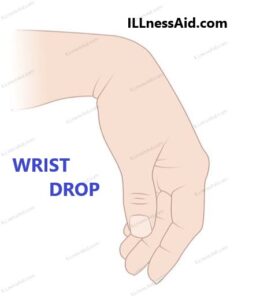 wrist drop