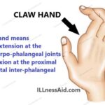 claw hand