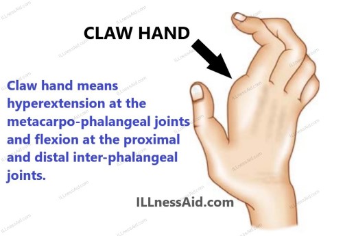 Claw Hand How PT And OT Can Help ILLnessAid   Claw Hand 