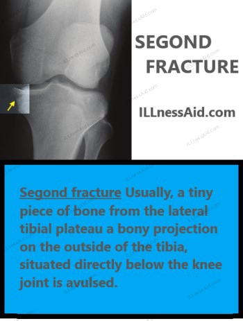 SEGOND FRACTURE