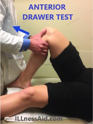 ANTERIOR DRAWER TEST