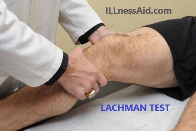 LACHMAN TEST