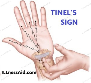 tinel's sign for cubital tunnel syndrome